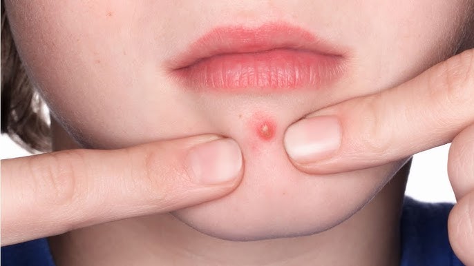 DOCTORS WARN AGAINST PIMPLE-POPPING IN THE ‘TRIANGLE OF DEATH’ ON THE FACE